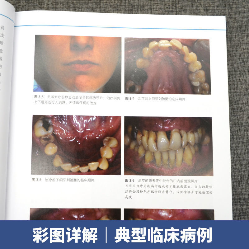 口腔精萃系列--口腔種植工藝操作流程:分步驟操作指南 口腔精萃系列--口腔種植工藝操作流程:分步驟操作指南